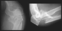 Upper Forearm fracture(Pre-op)